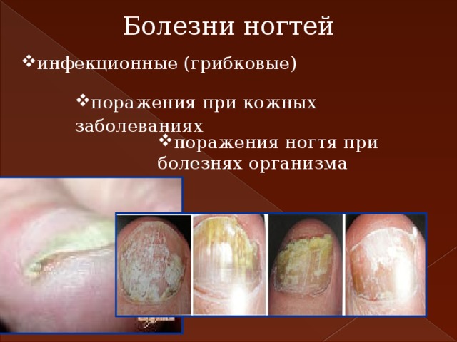 Болезни ногтей инфекционные (грибковые) поражения при кожных заболеваниях поражения ногтя при болезнях организма