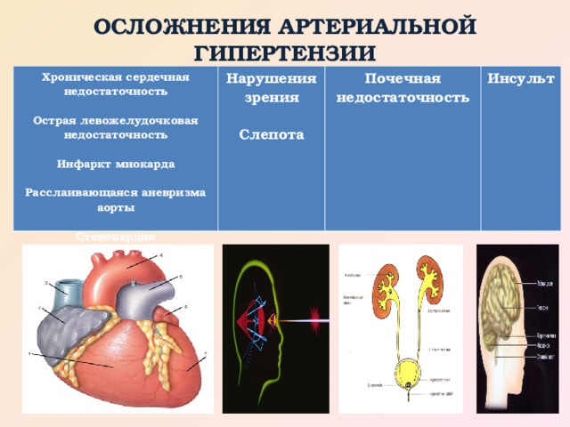 ОСЛОЖНЕНИЯ АРТЕРИАЛЬНОЙ ГИПЕРТЕНЗИИ               Хроническая сердечная недостаточность  Острая левожелудочковая недостаточность  Инфаркт миокарда  Расслаивающаяся аневризма аорты  Стенокардия Нарушения зрения  Слепота Почечная недостаточность Инсульт