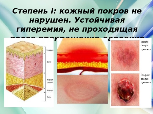 Степень I: кожный покров не нарушен. Устойчивая гиперемия, не проходящая после прекращения давления