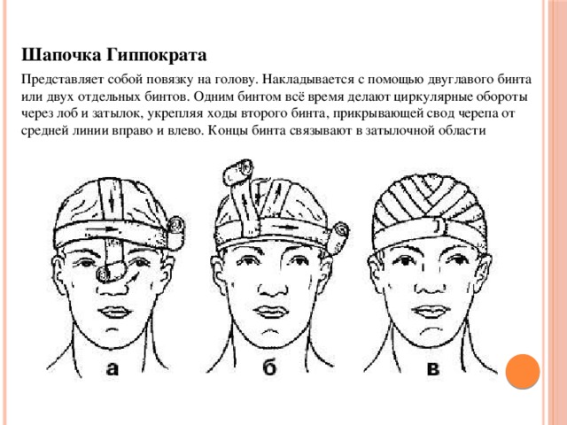 Шапочка Гиппократа Представляет собой повязку на голову. Накладывается с помощью двуглавого бинта или двух отдельных бинтов. Одним бинтом всё время делают циркулярные обороты через лоб и затылок, укрепляя ходы второго бинта, прикрывающей свод черепа от средней линии вправо и влево. Концы бинта связывают в затылочной области