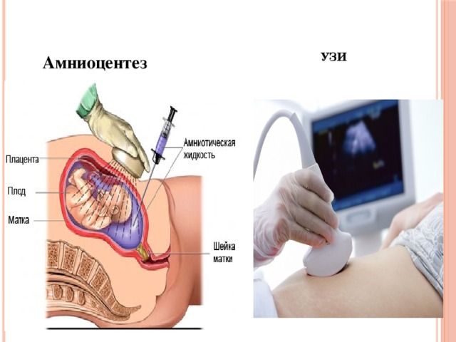 УЗИ Амниоцентез  