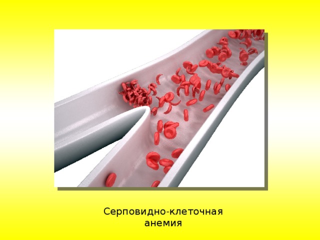 Серповидно - клеточная анемия 