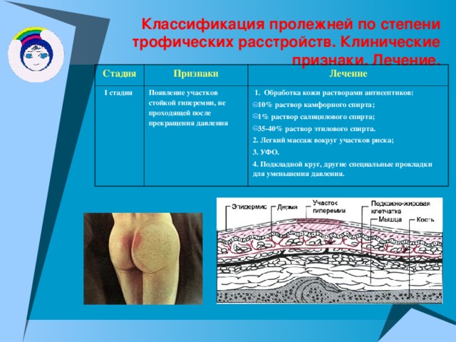 Классификация пролежней по степени трофических расстройств. Клинические признаки. Лечение. Стадия Признаки I стадия Лечение Появление участков стойкой гиперемии, не проходящей после прекращения давления   1. Обработка кожи растворами антисептиков: 10% раствор камфорного спирта; 1% раствор салицилового спирта; 35-40% раствор этилового спирта. 2. Легкий массаж вокруг участков риска; 3. УФО. 4. Подкладной круг, другие специальные прокладки для уменьшения давления. 