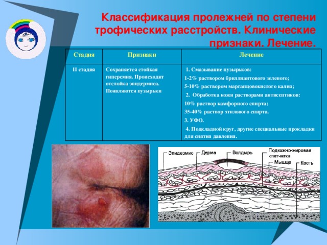 Классификация пролежней по степени трофических расстройств. Клинические признаки. Лечение. Стадия Признаки II стадия Лечение Сохраняется стойкая гиперемия. Происходит отслойка эпидермиса. Появляются пузырьки   1. Смазывание пузырьков: 1-2% раствором бриллиантового зеленого; 5-10% раствором марганцовокислого калия;  2. Обработка кожи растворами антисептиков: 10% раствор камфорного спирта; 35-40% раствор этилового спирта. 3. УФО.  4. Подкладной круг, другие специальные прокладки  для снятия давления. 