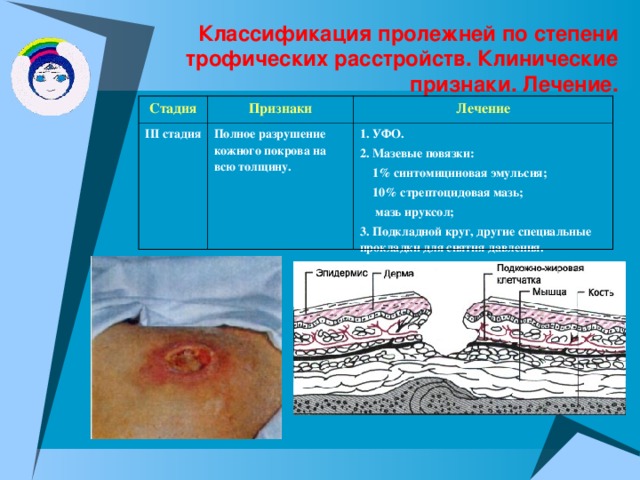 Классификация пролежней по степени трофических расстройств. Клинические признаки. Лечение. Стадия Признаки II I  стадия Лечение Полное разрушение кожного покрова на всю толщину. 1. УФО. 2. Мазевые повязки:  1% синтомициновая эмульсия;  10% стрептоцидовая мазь;  мазь ируксол; 3. Подкладной круг, другие специальные прокладки для снятия давления.  