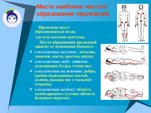 Места наиболее частого  образования пролежней.  Пролежни могут образовываться везде,  где есть костные выступы.  Место образования пролежней зависит от положения больного : в положении на спине :  затылок, лопатки, локти, крестец, пятки; в положении сидя:  лопатки ,  седалищные бугры, стопы ног; в положении на животе:  ребра, гребни подвздошных костей, колени, пальцы ног с тыльной стороны; в положении на боку:  область тазобедренного сустава (область большого вертела). 