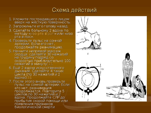 Схема действий  1. Уложите пострадавшего лицом вверх на жёсткую поверхность. 2. Запрокиньте его голову назад. 3. Сделайте больному 2 вдоха по методу « изо рта в рот » или «изо рта в нос». 4. Проверьте пульс на сонной артерии. Если его нет, продолжайте реанимацию. 5. Начните непрямой массаж сердца: сделайте 30 нажатий на грудину подряд со скоростью приблизительно 100 нажатий в минуту [1] . 6. Ещё 2 вдоха искусственного дыхания. Сделайте 4 таких цикла (по 30 нажатий и 2 вдоха) [1] . 7. После этого вновь проверьте пульс на сонной артерии. Если его нет, реанимация продолжается. Повторите 5 циклов по 30 нажатий и 2 вдоха. Продолжайте СЛР до прибытия скорой помощи или появления признаков биологической смерти 