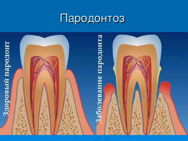 Пародонтоз