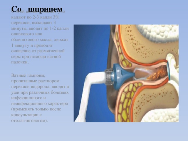 Со шприцем С этой целью в каждое ухо капают по 2-3 капли 3% перекиси, выжидают 3 минуты, вводят по 1-2 капли оливкового или облепихового масла, держат 1 минуту и проводят очищение от размягченной серы при помощи ватной палочки. Ватные тампоны, пропитанные раствором перекиси водорода, вводят в уши при различных болезнях инфекционного и неинфекционного характера (применять только после консультации с отолагингологом).