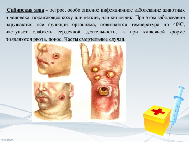 Сибирская язва – острое, особо опасное инфекционное заболевание животных и человека, поражающее кожу или лёгкие, или кишечник. При этом заболевании нарушаются все функции организма, повышается температура до 40 0 С, наступает слабость сердечной деятельности, а при кишечной форме появляются рвота, понос. Часты смертельные случаи.